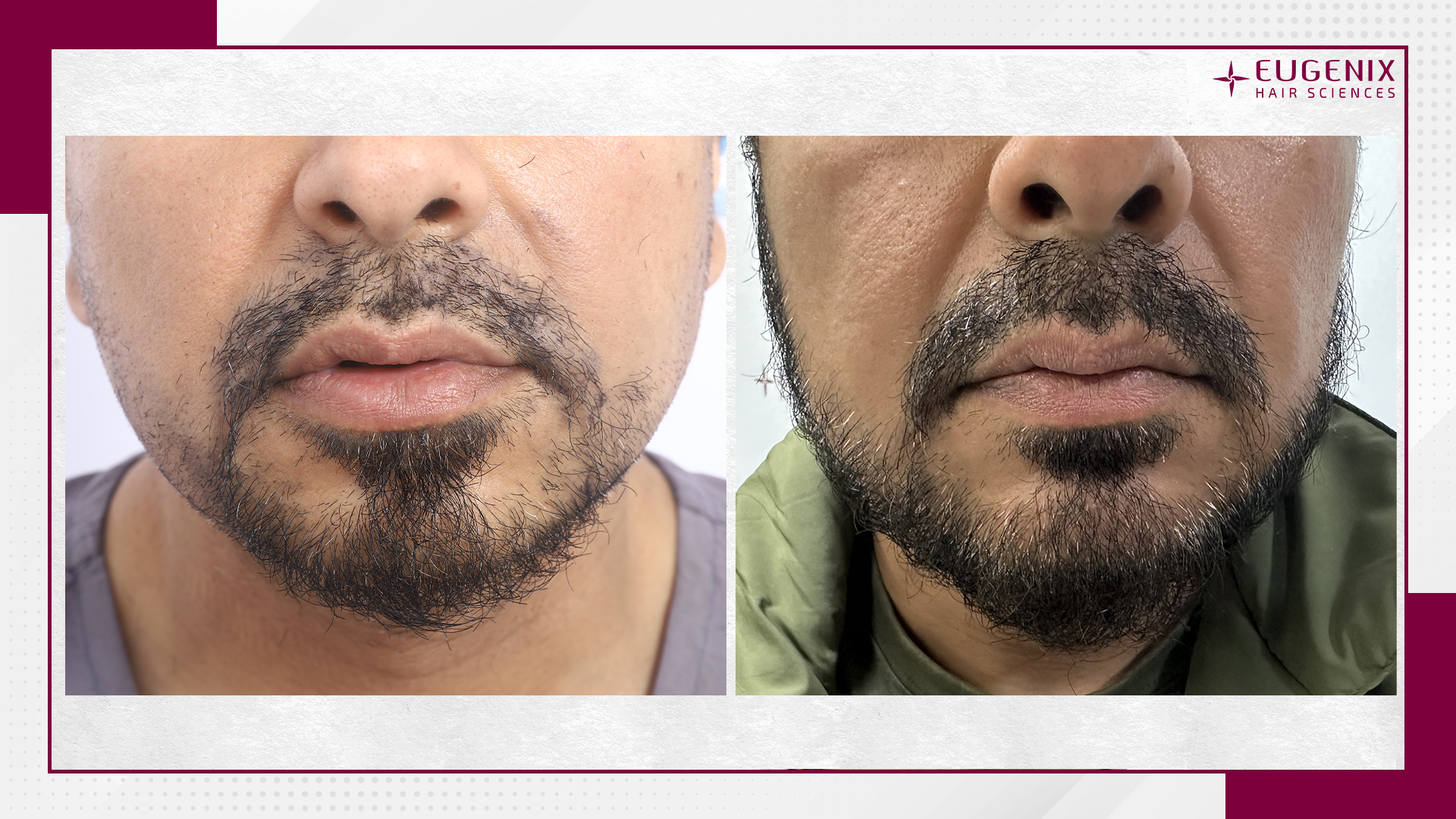 moustache-hair-transplant-before-and-after-uk-1