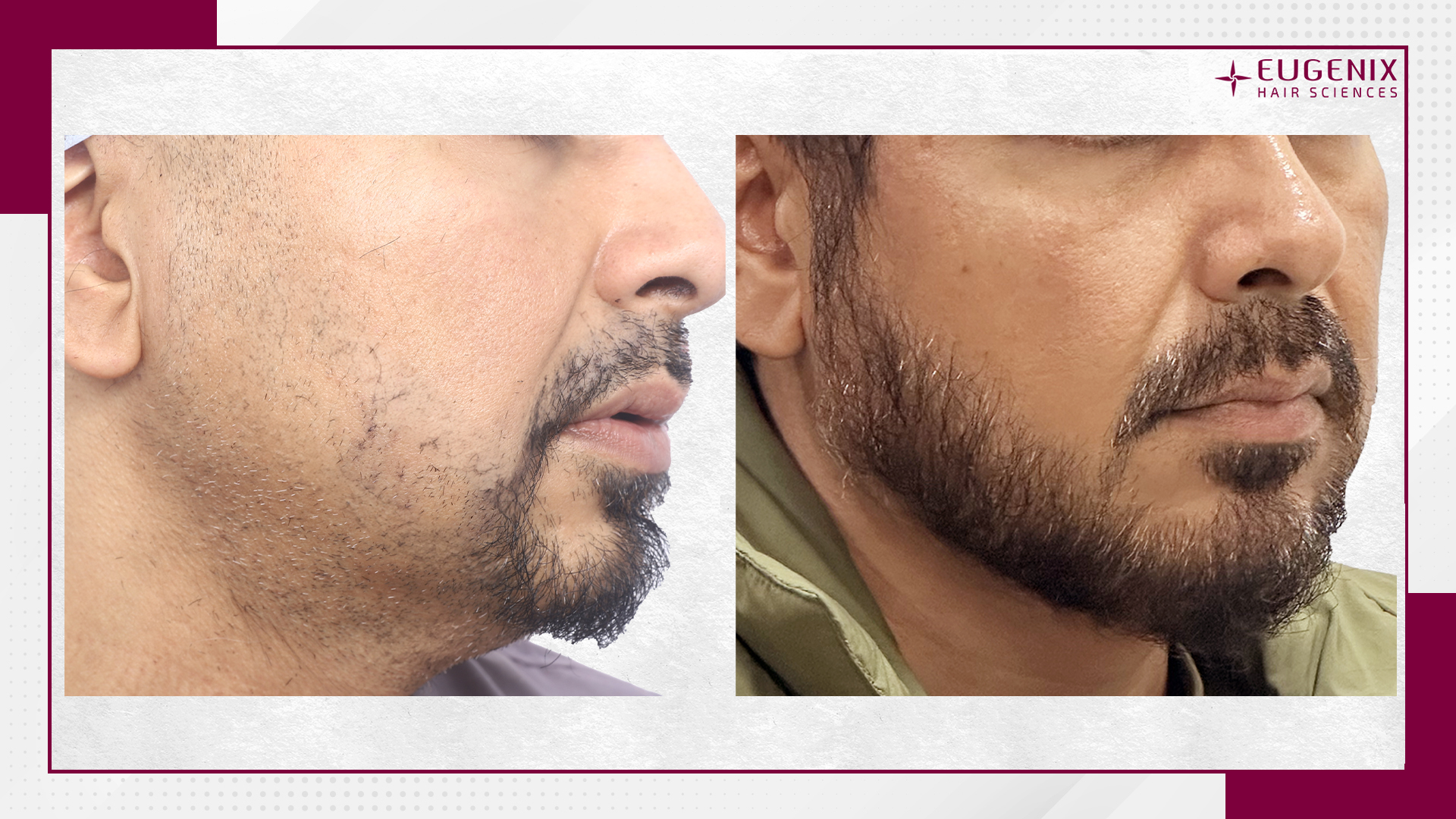 moustache-hair-transplant-before-and-after-uk-2