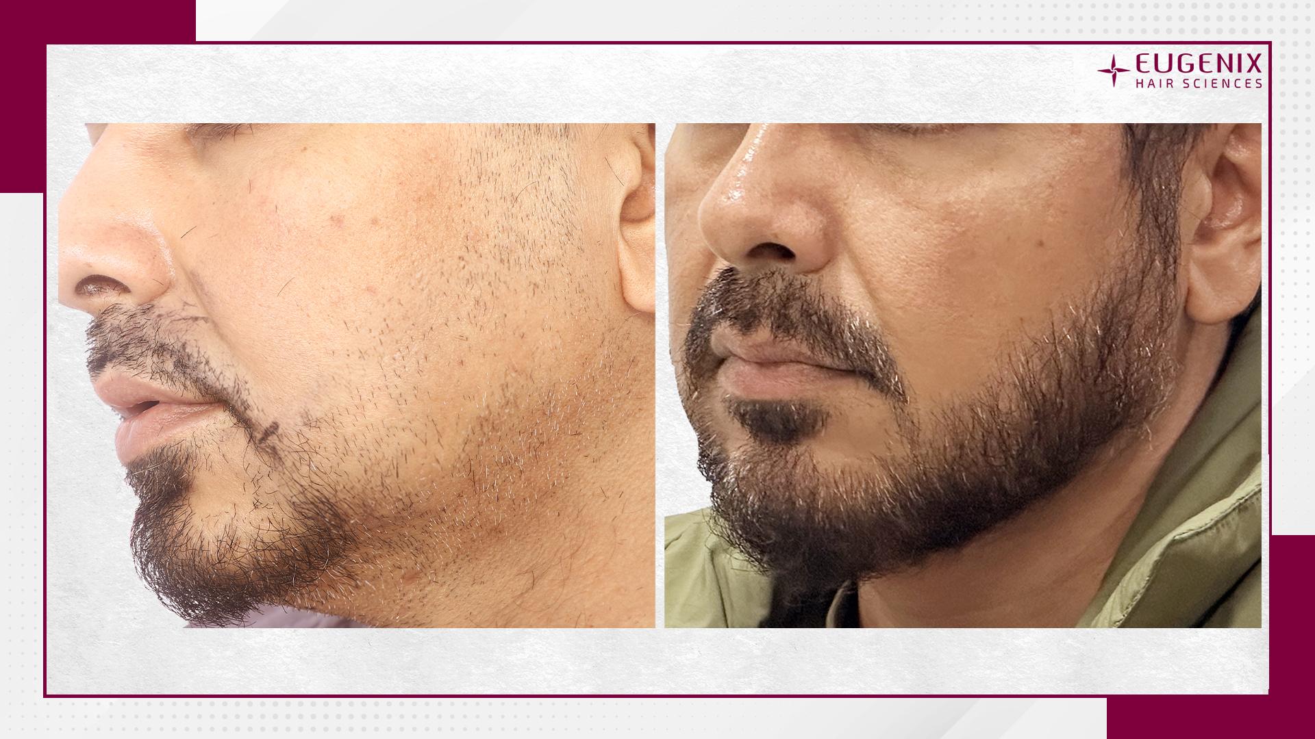 moustache-hair-transplant-before-and-after-uk-3