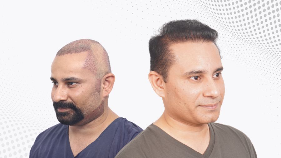 temple-hair-transplant-before-and-after-uk