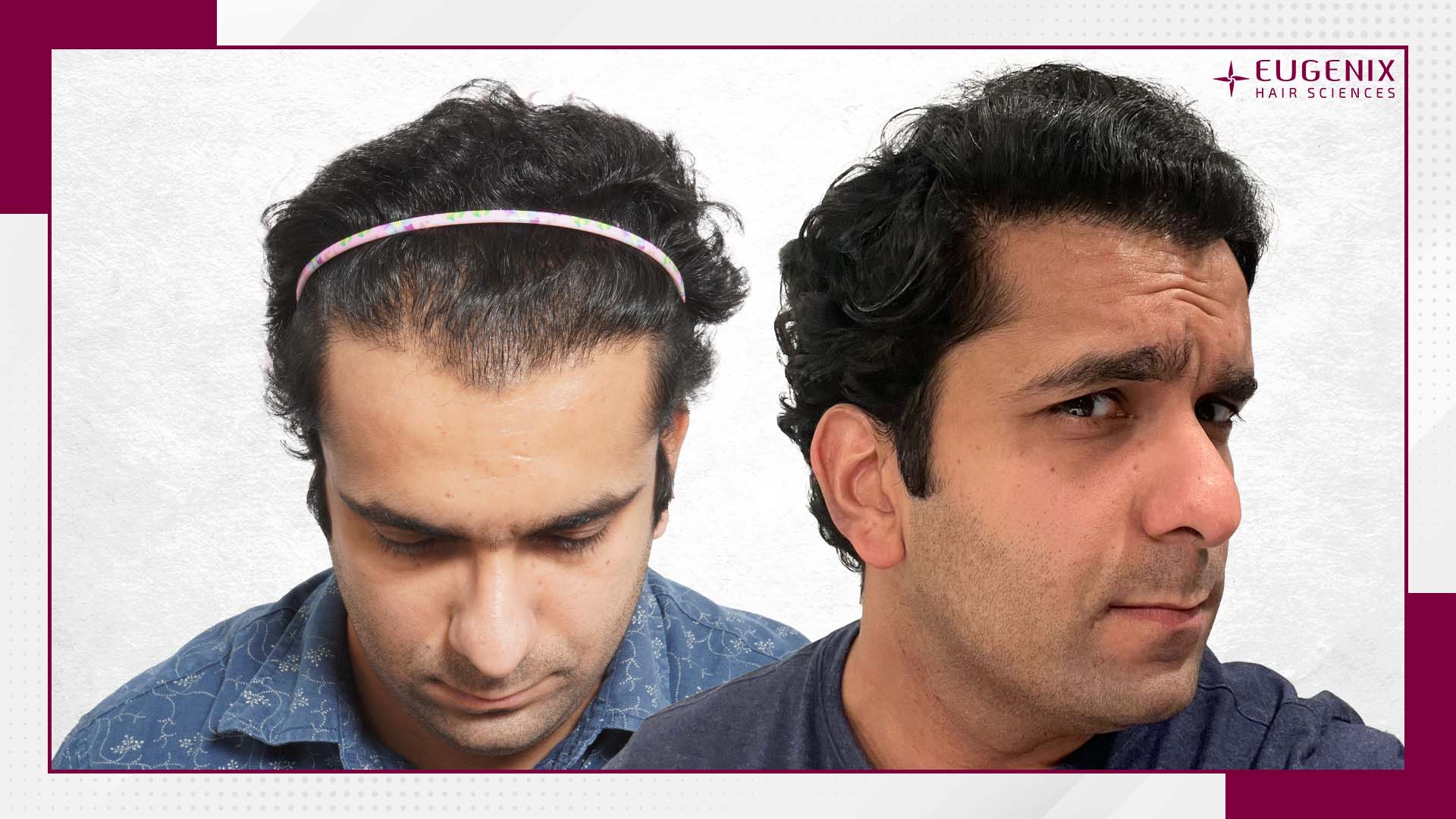 unshaven-hair-transplant-before-and-after-uk-1