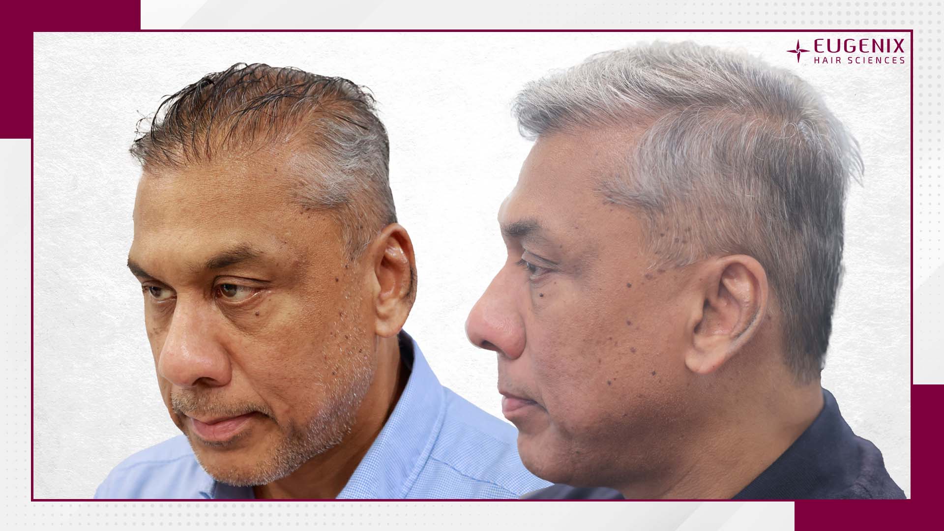 unshaven-hair-transplant-before-and-after-uk-3