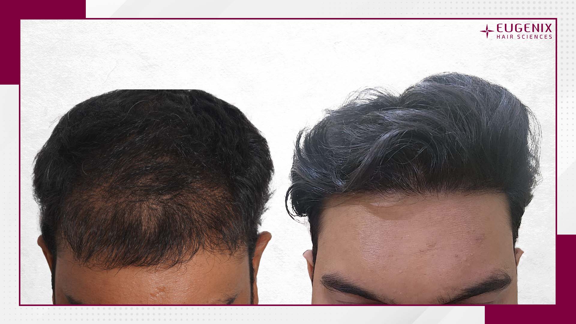 unshaven-hair-transplant-before-and-after-uk-4
