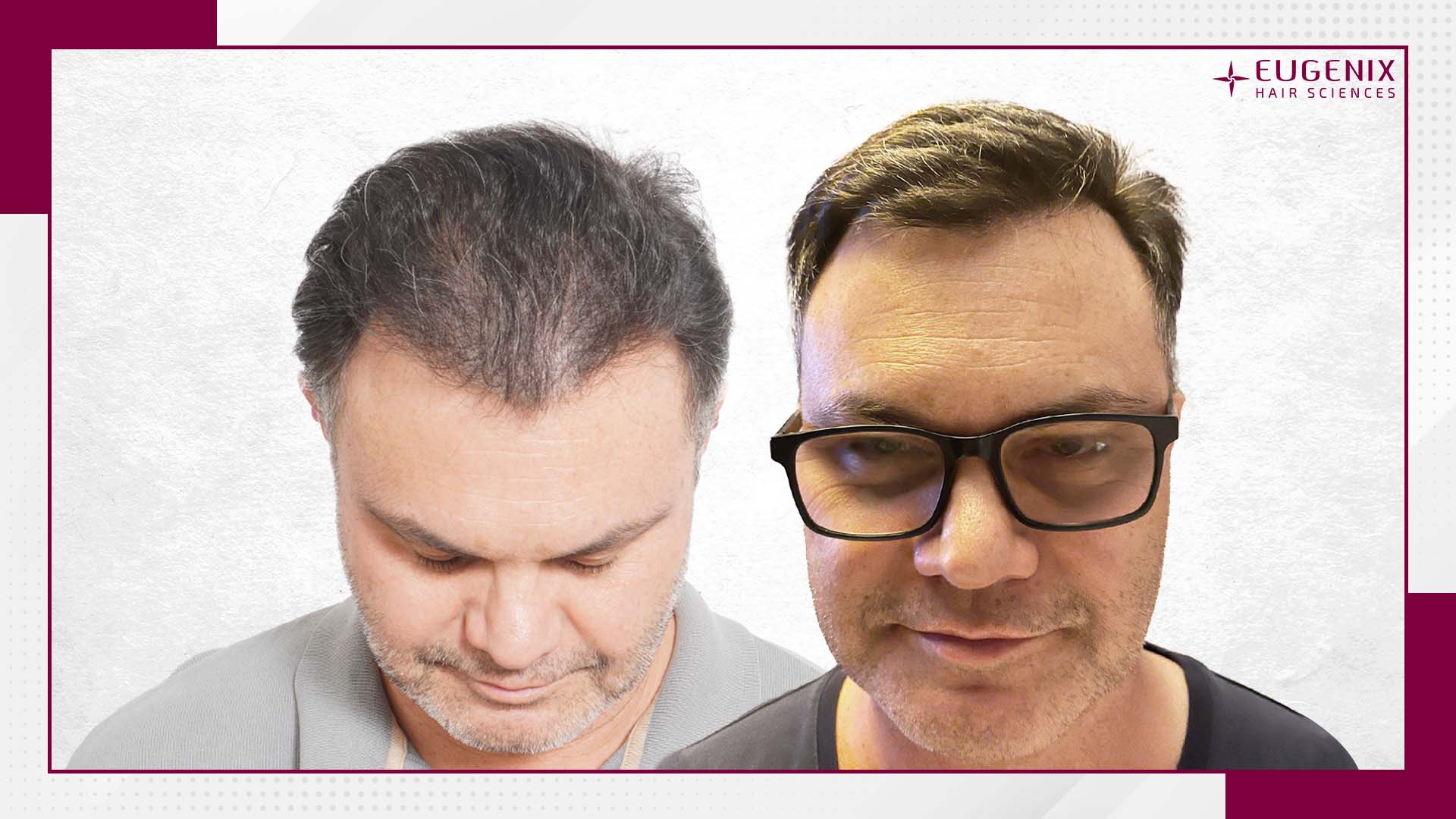 unshaven-hair-transplant